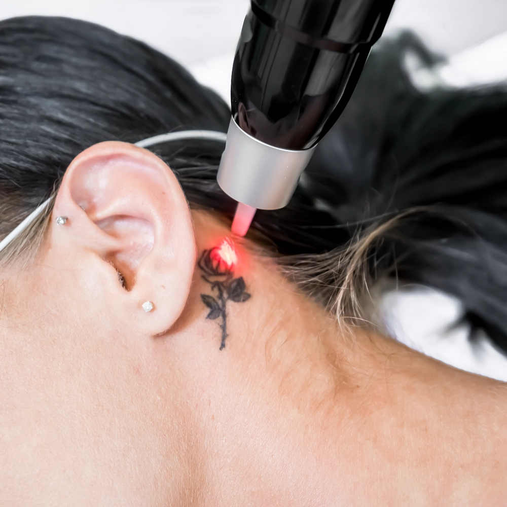 Tatuaje detras de oreja eliminado con laser