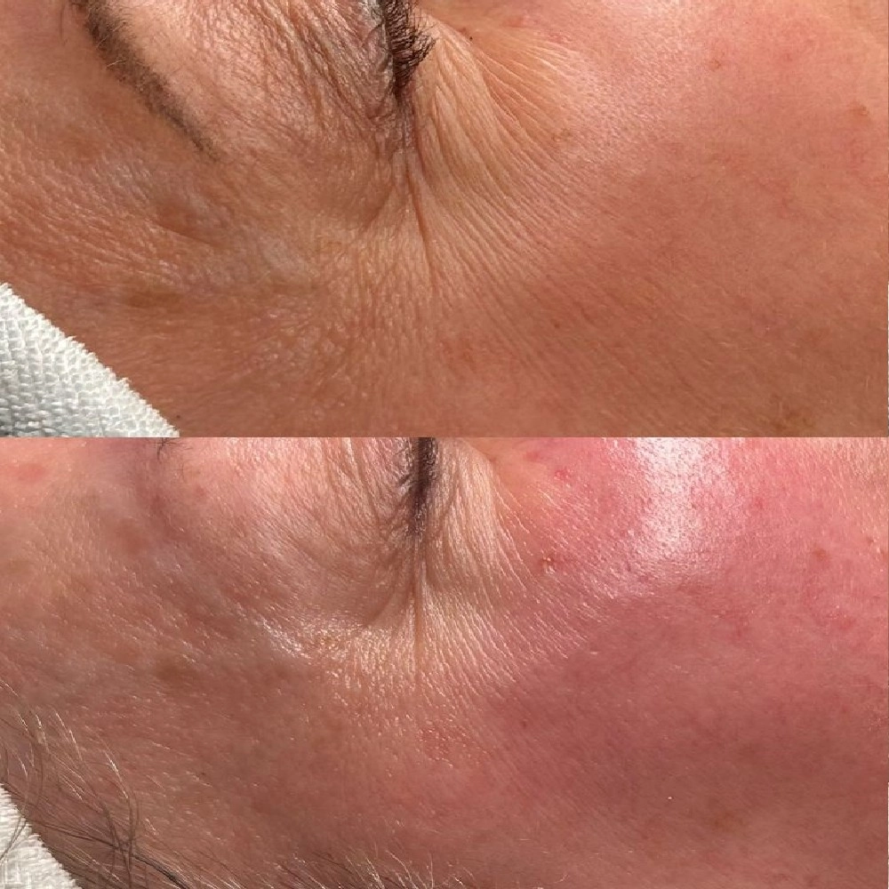 Fotografía de tratamiento de Eye Lift