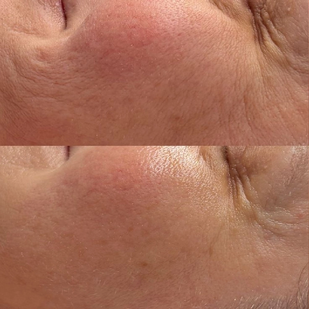 Fotografía de un tratamiento facial antiarrugas 